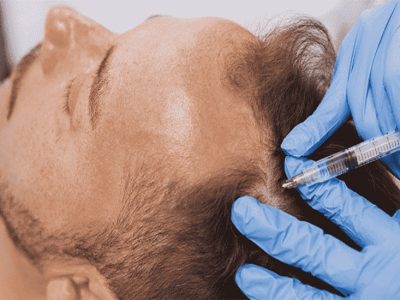 عوارض پی آر پی مو تا چه اندازه جدی است؟